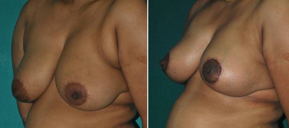 Breast lift surgery in Kerala,India